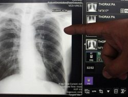 Dokter Tegaskan Herbal Tidak Bisa Menyembuhkan TBC, Pengobatan Medis Tetap Utama